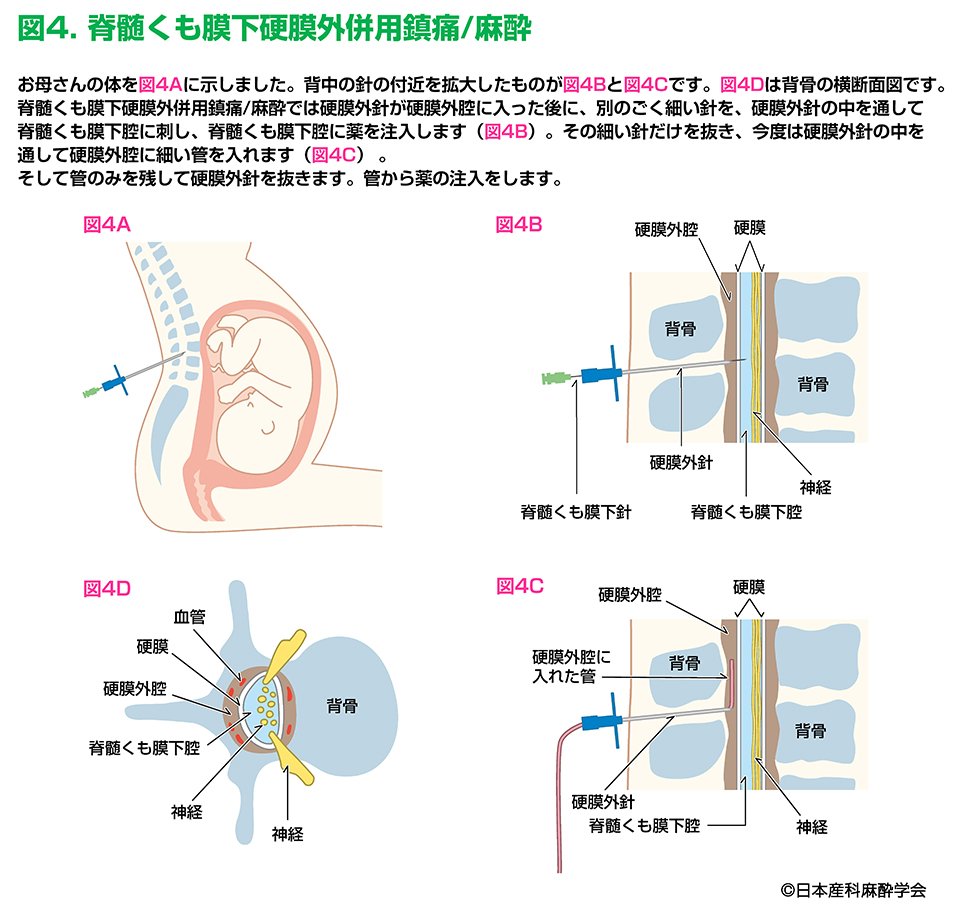 採卵 局所 麻酔 どこに