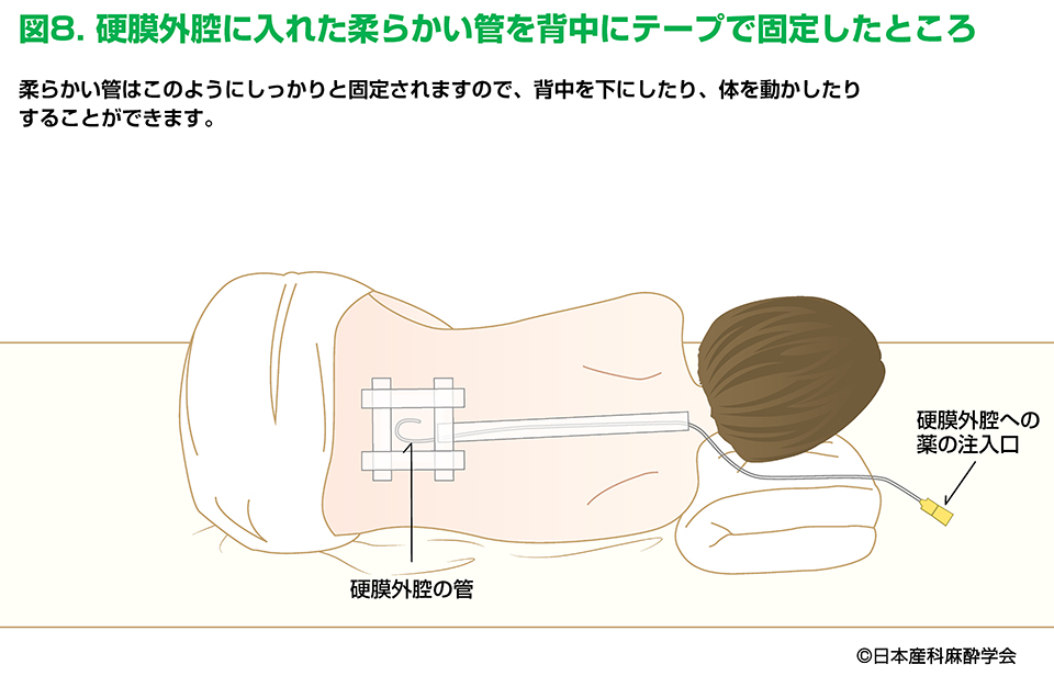 腰痛は硬膜外麻酔の副作用ですか?